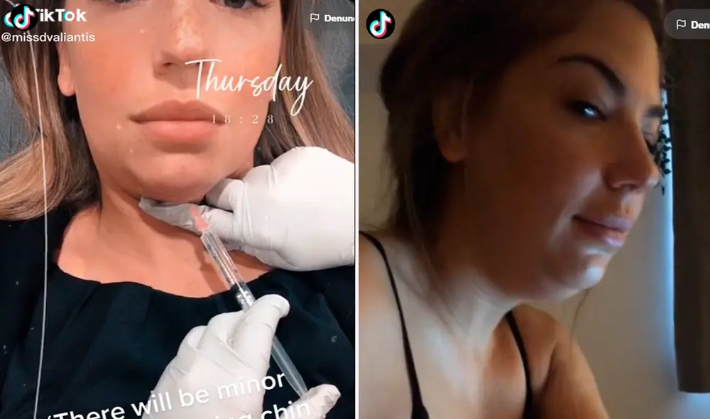 El rostro de la muchacha dio mucho de qué hablar, pues algunos usuarios que se sometieron al tratamiento no quedaron satisfechos. Foto: composición de LR/TikTok/@Señoritavaliente El rostro de la muchacha dio mucho de qué hablar, pues algunos usuarios que se sometieron al tratamiento no quedaron satisfechos. Foto: composición de LR/TikTok/@Señoritavaliente