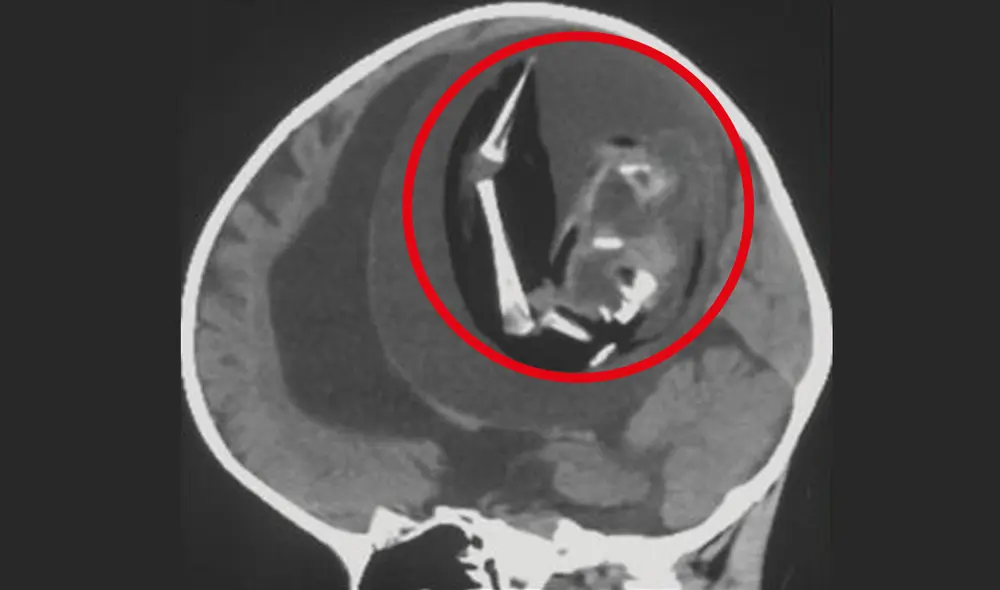 Tomografía computarizada de la cabeza de la bebé. Se resalta la ubicación del feto malformado. Foto: composición LRLi et al./Neurology