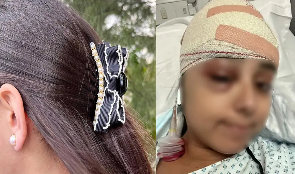 La joven pasó semanas con el gancho de pelo incrustado en su cuero cabelludo. Foto: composición LR/Wandafund/Kennedy News and Media