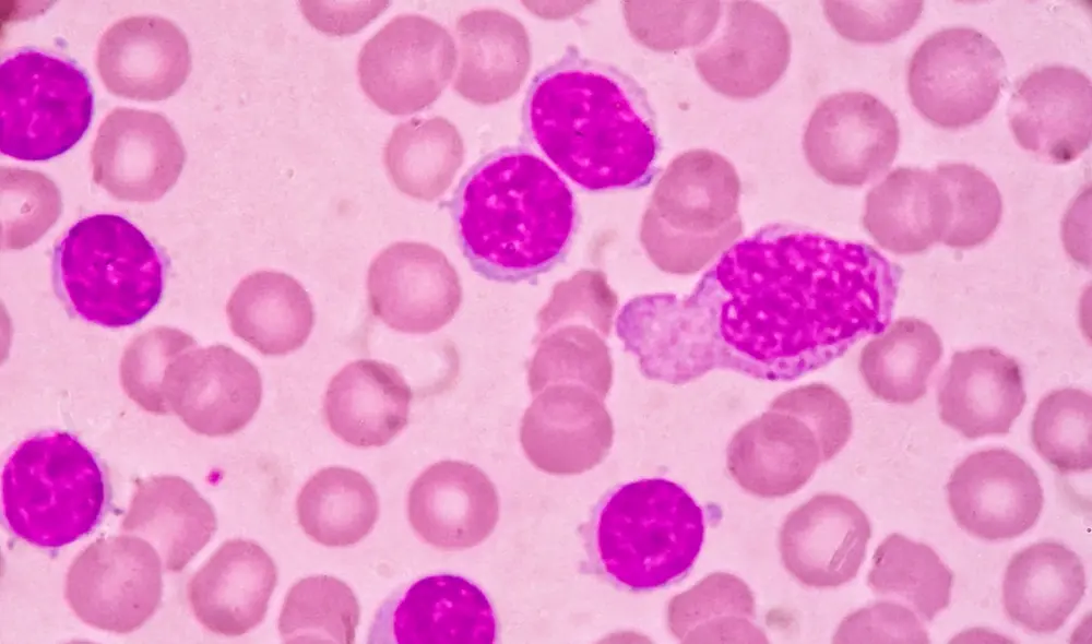 Células cancerosas en un paciente con leucemia mieloide aguda. Foto: Weill Cornell Medicine