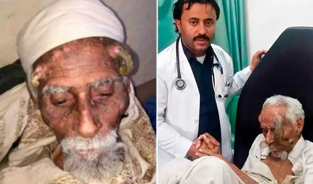 Según medios locales, las 2 protuberancias en forma de cuerno de la cabeza del hombre aparecieron después de cumplir los 100 años. Foto: The Mirror