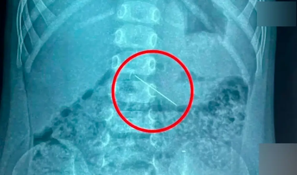 Un niño de 3 años estaba jugando y se tragó 2 agujas, una de ellas está en su intestino. Foto: NTV Un niño de 3 años estaba jugando y se tragó 2 agujas, una de ellas está en su intestino. Foto: NTV
