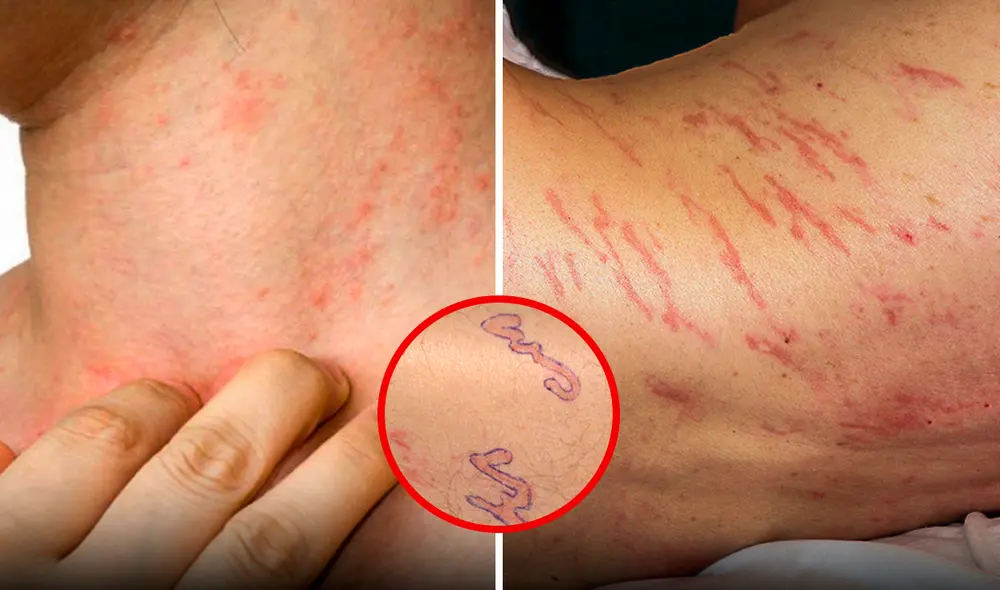 Un hombre descubrió que tenía gusanos que se movían debajo de su piel. Foto: The New England Journal of Medicine/Infofueguina/referencial Un hombre descubrió que tenía gusanos que se movían debajo de su piel. Foto: The New England Journal of Medicine/Infofueguina/referencial