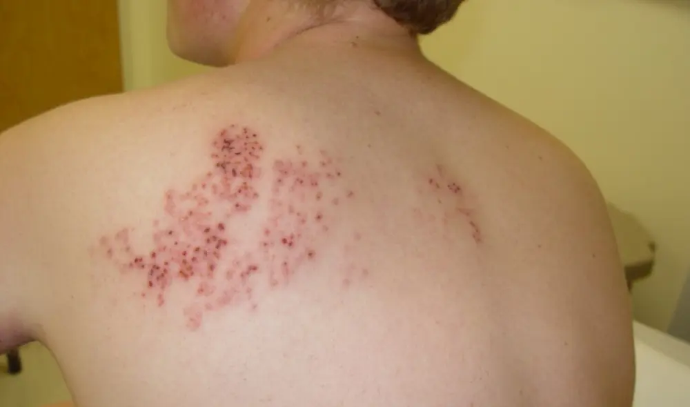 Ampollas del herpes zóster, una infección causada por la reactivación del virus de la varicela-zóster. Foto: El siglo de Torreón