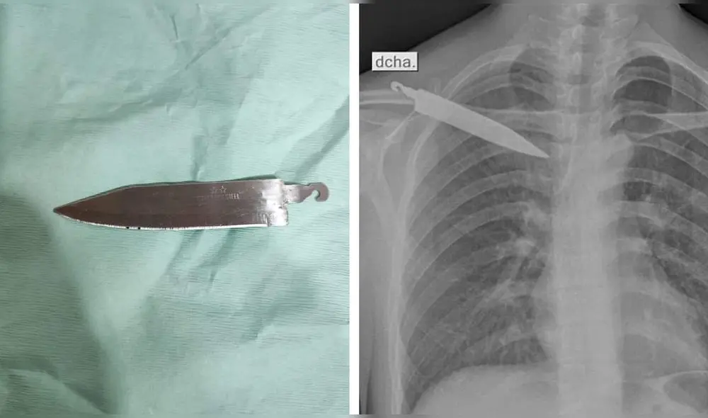 El hombre no podía levantar los brazos debido al dolor. Foto: Capturas Hospital San Martín de Pangoa