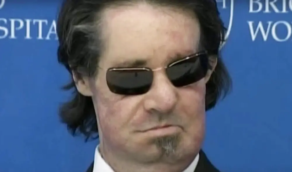 Dallas Wiens y su nuevo rostro. Foto: Brigham and Women’s Hospital Dallas Wiens y su nuevo rostro. Foto: Brigham and Women’s Hospital