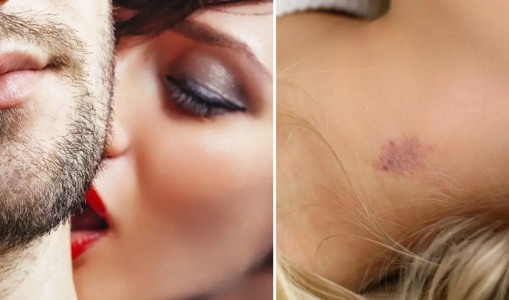 Conoce cómo eliminar los chupetones sin usar maquillaje de manera rápida y sencilla. Foto: composición LR/El Confidencial/El Tiempo