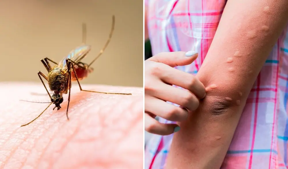 Generalmente, las picaduras de mosquitos producen hinchazón y picazón. Foto: composición LR/difusión/Freepik