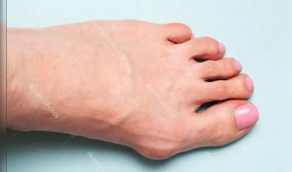 En los pies suelen aparecer juanetes y estas son las causas. Foto: Depositphotos