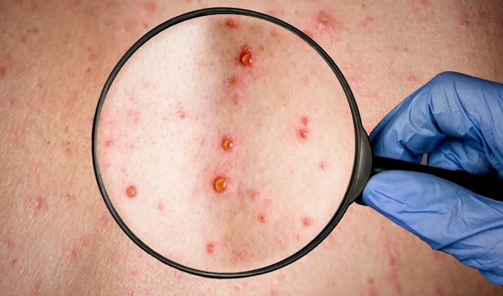 En los 10 meses del brote de la viruela del mono, América acabó siendo la región que declaró más contagios. Foto: EFE