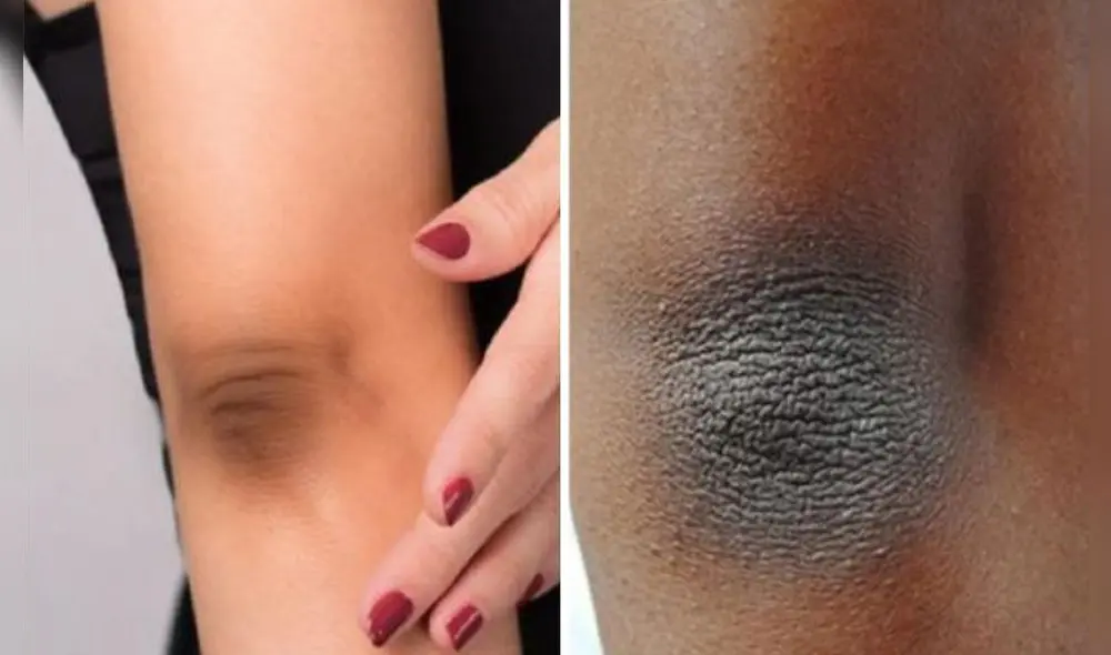 Existen diversos factores que ocasionan el oscurecimiento; sin embargo, mayormente no es un problema de salud. Foto: Libertt Internacional/Facebook