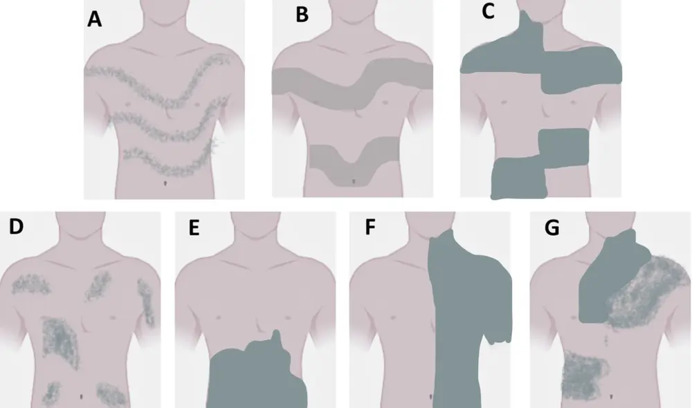 En las dos primeras ilustraciones se presentan casos de pigmentación en la piel relacionadas a las líneas de Blaschko, patrones invisibles en la anatomía humana. Foto: Orphanet Journal of Rare Diseases