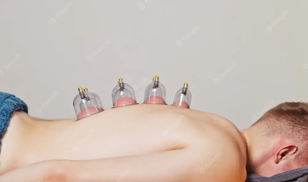 Las ventosas son un tipo de remedio casero para el fuerte dolor de espalda. Foto: Freepik.