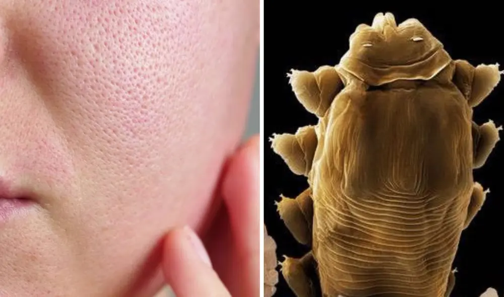 Los Demodex folliculorum, ácaros microscópicos que viven en nuestro rostro, salen de los poros para encontrar un nuevo folículo de piel, buscar pareja y aparearse. Foto: composición LR/Difusión/National Geographic Los Demodex folliculorum, ácaros microscópicos que viven en nuestro rostro, salen de los poros para encontrar un nuevo folículo de piel, buscar pareja y aparearse. Foto: composición LR/Difusión/National Geographic