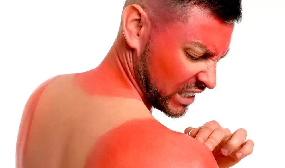 Recuerda no exponerte al sol por mucho tiempo sin antes haberle aplicado protector solar. Foto: Cuídate Plus