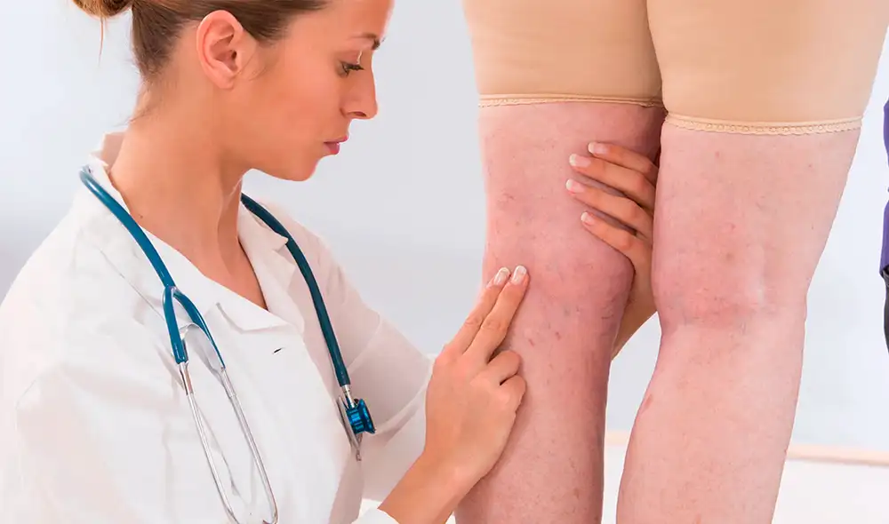 Las várices en las piernas son producidas por una mala circulación sanguínea. Foto: Mejor con salud