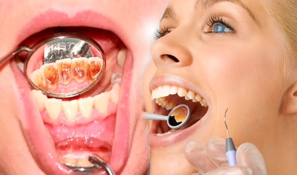 Descubre cómo reducir los niveles de sarro en tus dientes de manera natural. Foto: composición/Semana/Rob Dental