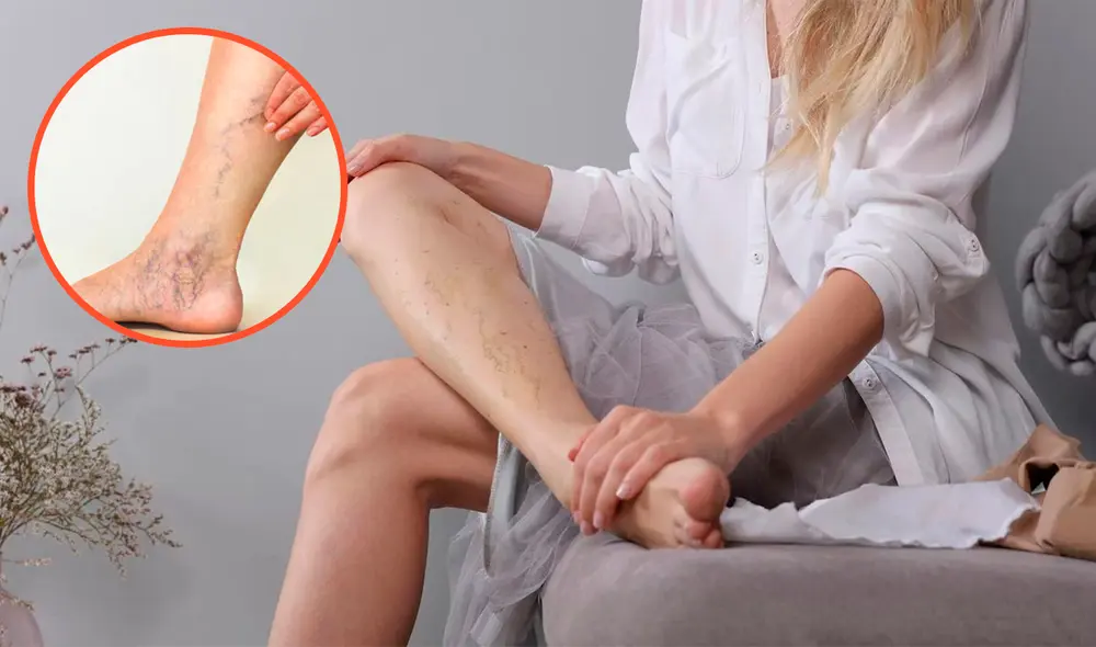 Prevén la aparición de várices en las piernas consumiendo esta vitamina. Foto: composición/iStockphotos/difusión