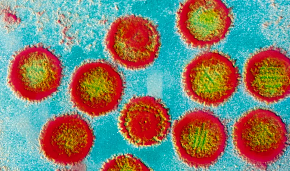 Imagen microscópica de virus VEB. Foto: Science Source