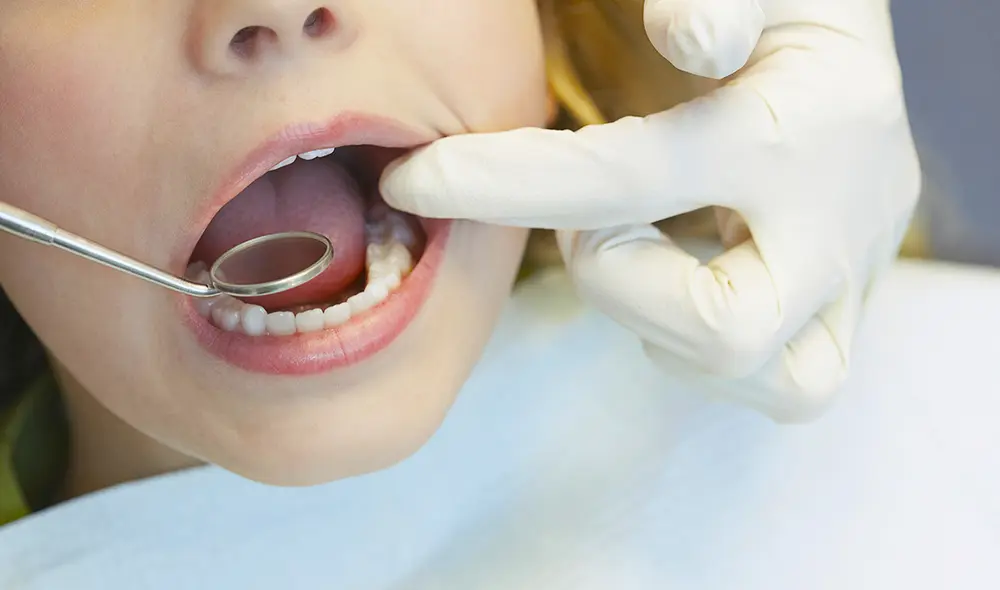 En Colombia, una niña de 8 años murió tras una extracción de muela. Foto: UCSF En Colombia, una niña de 8 años murió tras una extracción de muela. Foto: UCSF