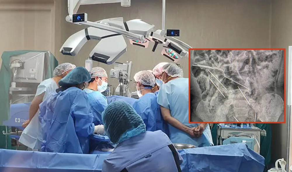 Cirugía realizada por médicos de Hospital de Tarapoto a niño fue exitosa. Foto: composición LR/Hospital de Tarapoto