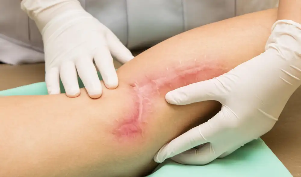 Una cicatriz puede tardar hasta 18 meses en desaparecer, por lo general. Foto: Medline Plus