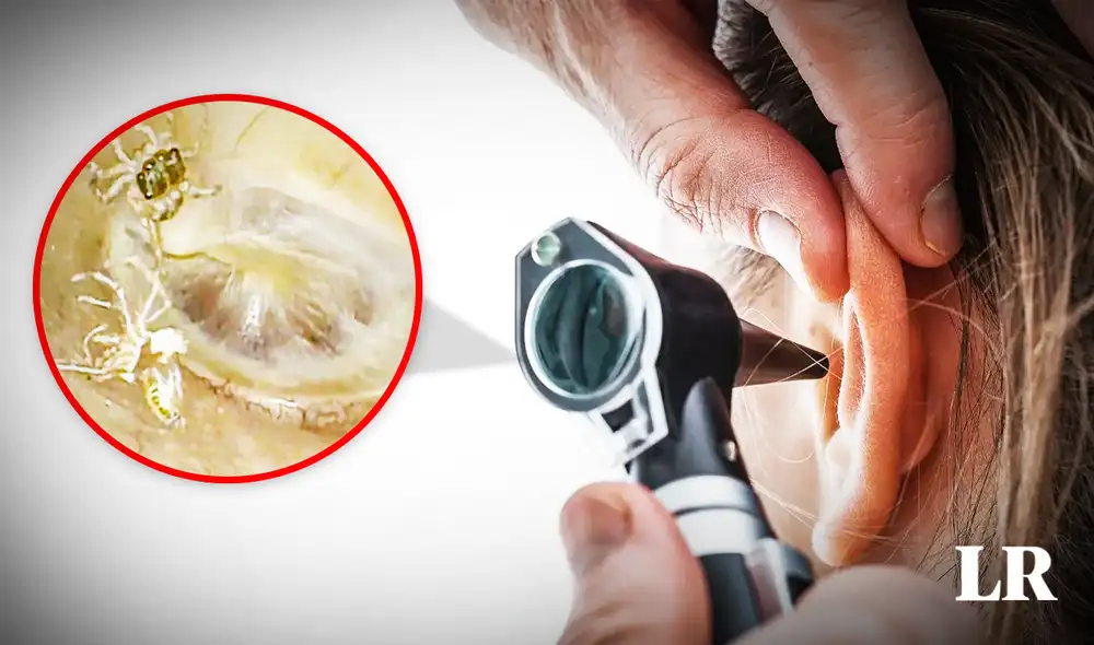 El arácnido vivía en su oído interno y había mudado de piel. Foto: composición de Jazmin Ceras / NEJM El arácnido vivía en su oído interno y había mudado de piel. Foto: composición de Jazmin Ceras / NEJM