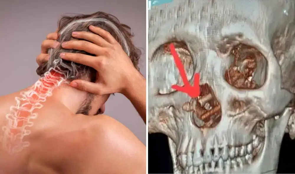 De acuerdo con médicos en Vietnam, los palillos habrían ingresado por las fosas nasales del paciente. Foto: composición LR/Shutterstock/BVCC De acuerdo con médicos en Vietnam, los palillos habrían ingresado por las fosas nasales del paciente. Foto: composición LR/Shutterstock/BVCC