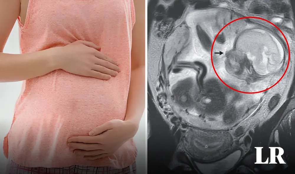 El bebé crecía en la cavidad peritoneal con la placenta adherida a la parte superior de la pelvis. Foto: composición LR/New England Journal of Medicine