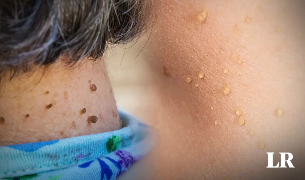 Los lunares de carne son pequeños tumores benignos que aparecen en ciertas partes de la piel. Foto: composición LR//AFP/Advance Dermatology