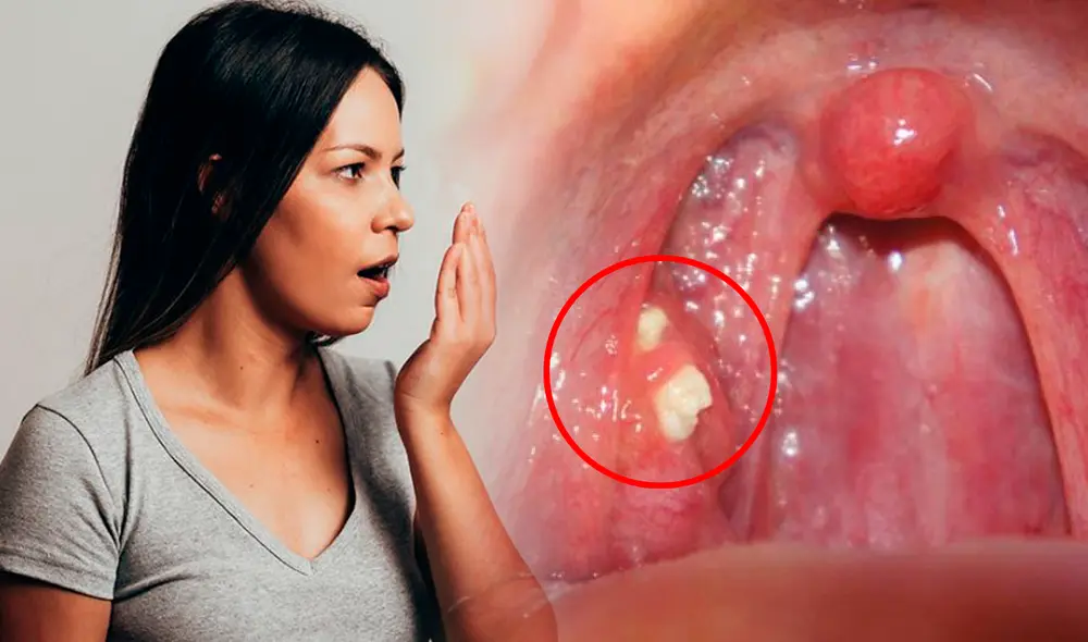 Además del mal aliento, estos cálculos amigdalinos pueden ocasionar molestias en la garganta. Foto: composición LR/BQDC/Ofertalaboral