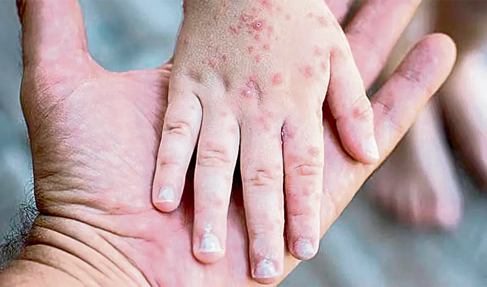 Peligro. No solo los niños están en riesgo con el sarampión, también los adultos mayores y personas con comorbilidades. Foto: difusión