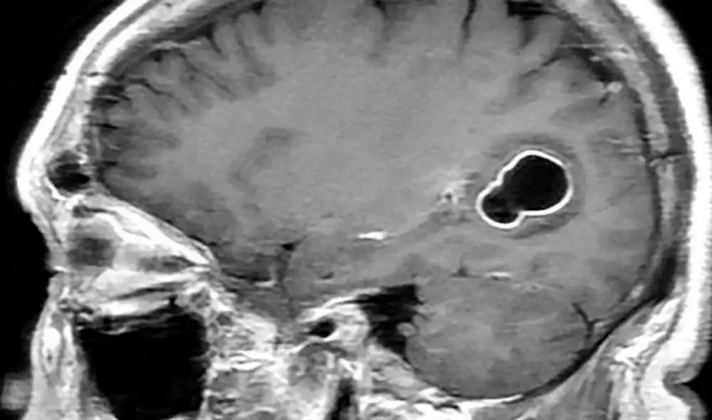 En esta imagen, se observa la lesión que causa la tenia de cerdo en el cerebro. Foto: SCIENCE PHOTO LIBRARY