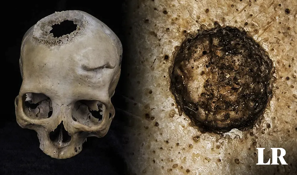 Científicos españoles examinaron un cráneo egipcio de 4.000 años de antigüedad. Evidencias apuntan a que fue operado por un tumor. Foto: composiciónLR/Fabrizio Oviedo/Frontiers in Medicine/Tondini, Isidro, Camarós