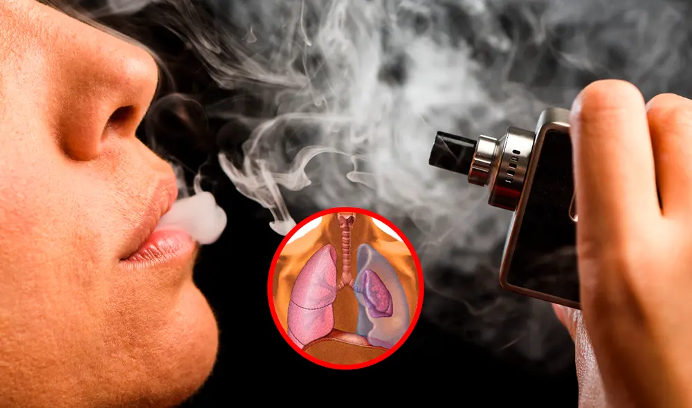 De acuerdo a Kyla, los especialistas le indicaron que los vapeadores desechables podrían estar detrás de la formación de estas peligrosas ampollas pulmonares. Foto: Composición LR/Semana/Mayoclinic. De acuerdo a Kyla, los especialistas le indicaron que los vapeadores desechables podrían estar detrás de la formación de estas peligrosas ampollas pulmonares. Foto: Composición LR/Semana/Mayoclinic.