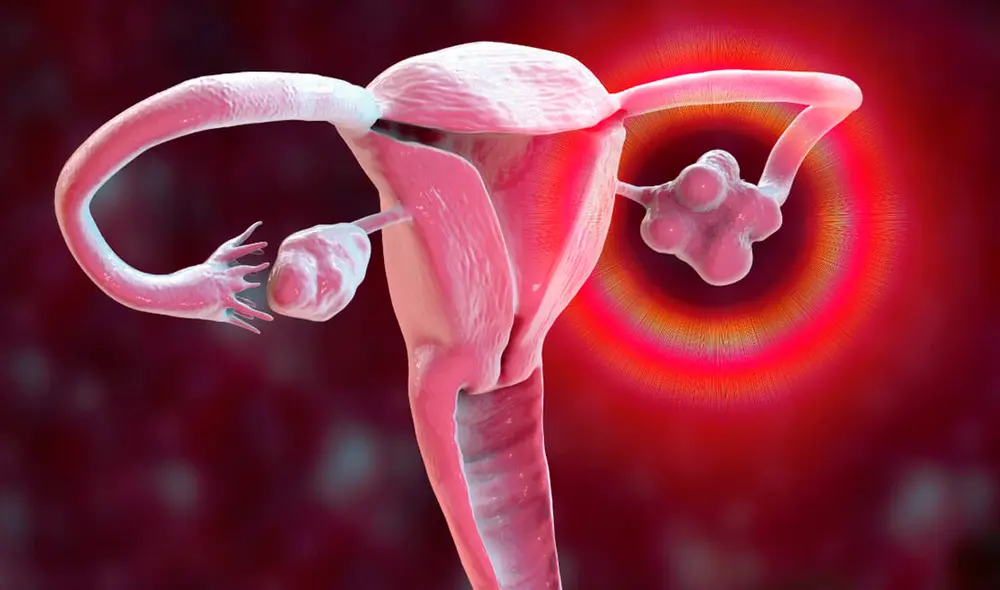 El cáncer de ovario se trata mejor cuando se detecta a tiempo. Foto: difusión