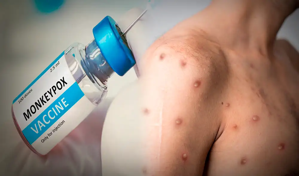 En Estados Unidos crece la preocupación por el aumento de casos de la viruela del mono alrededor del mundo. Foto: composición LR/AIS/TEC En Estados Unidos crece la preocupación por el aumento de casos de la viruela del mono alrededor del mundo. Foto: composición LR/AIS/TEC