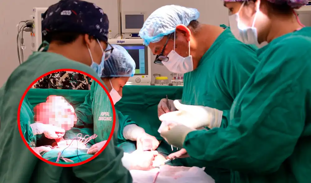 La miomatosis uterina gigante es una condición médica en la cual se desarrollan uno o más fibromas uterinos de gran tamaño dentro del útero. Foto: composición LR/Hospital de Chulucanas