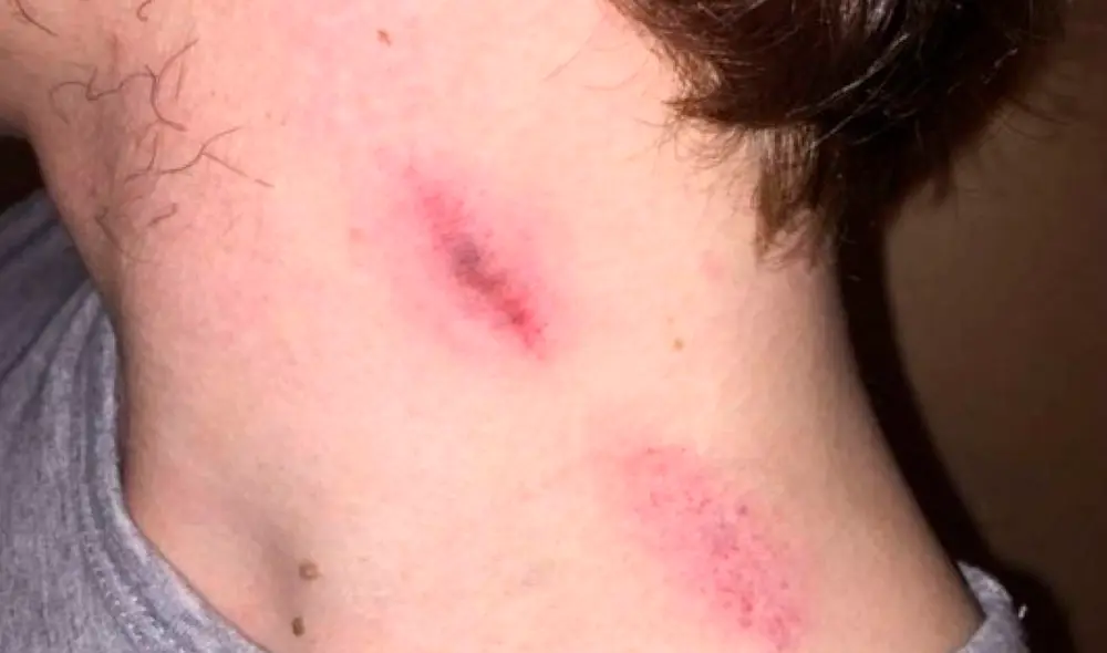 Los chupetones en el cuello puede desencadenar en enfermedades como herpes. Foto: difuasión