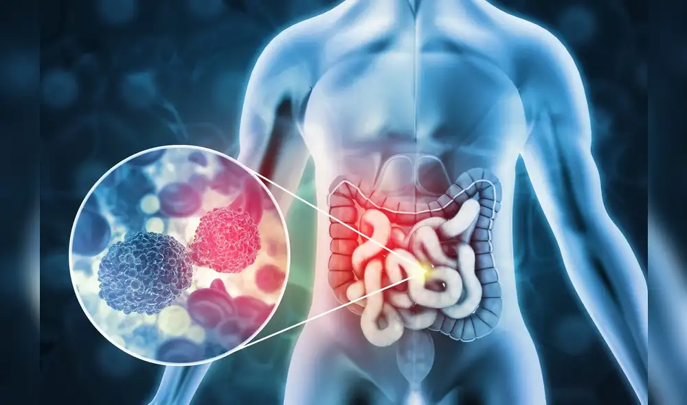 Estudio científico revela el alarmante aumento del cáncer de colon en menores de 50 años. Foto: Rocky Mountain Cancer Centers Estudio científico revela el alarmante aumento del cáncer de colon en menores de 50 años. Foto: Rocky Mountain Cancer Centers