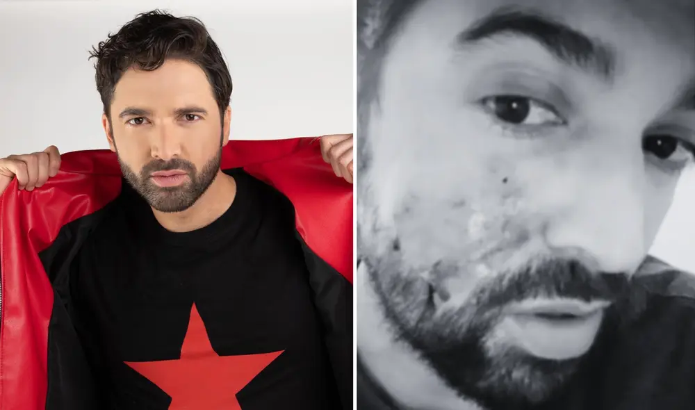 Carlos Girón Longoria fue atacado por un perro en la cara. Foto: Composición LR/Carlos Girón Longoria/Instagram Carlos Girón Longoria fue atacado por un perro en la cara. Foto: Composición LR/Carlos Girón Longoria/Instagram