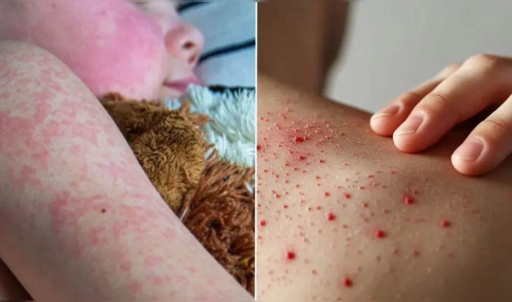 Según CDC, el resurgimiento de la enfermedad se debe a una baja tasa de vacunación en los últimos años. Foto: composición LR/AP/Infobae.