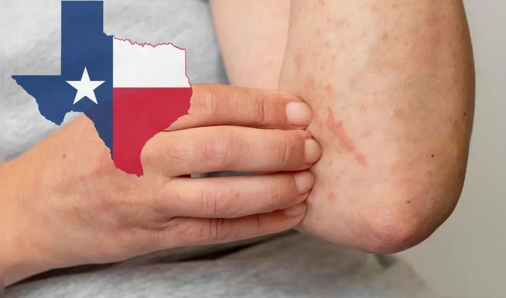 En total, son 9 condados de Texas que registran los mayores casos de contagios por sarampión. Foto: Composición LR/Freepik/PNGWing En total, son 9 condados de Texas que registran los mayores casos de contagios por sarampión. Foto: Composición LR/Freepik/PNGWing