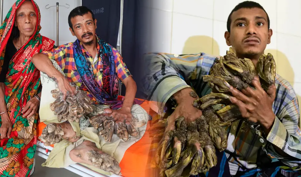 Abul Bajandar lleva cerca de 20 años con esta rara enfermedad. Foto: composición LR/Clarin/BBC Abul Bajandar lleva cerca de 20 años con esta rara enfermedad. Foto: composición LR/Clarin/BBC