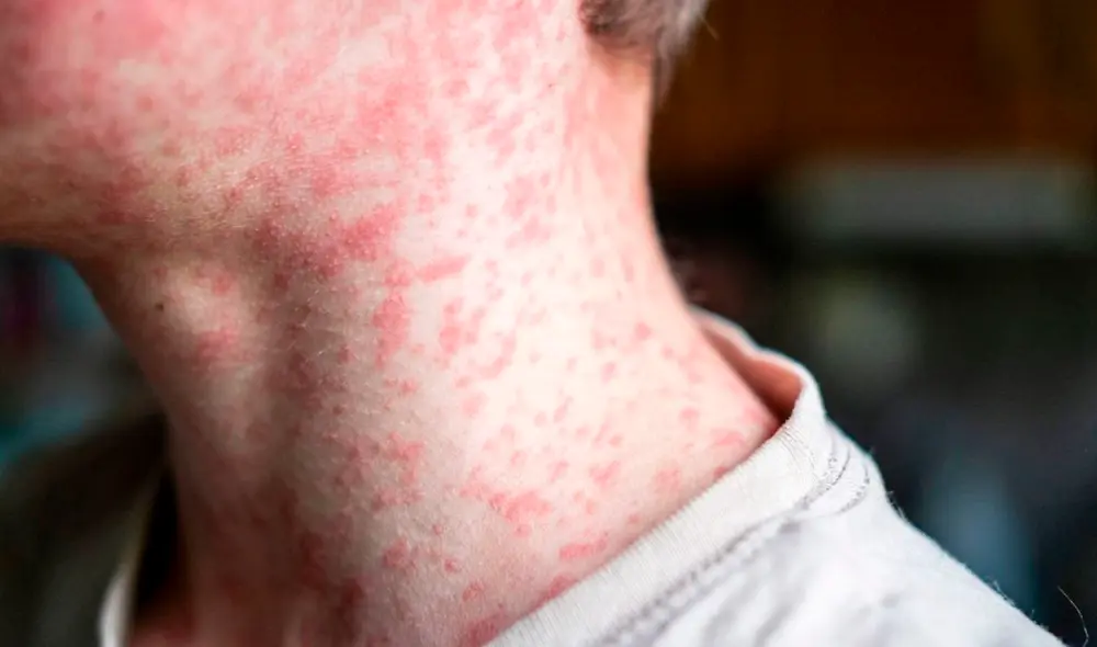 La enfermedad altamente contagiosa ha resurgido en EE. UU., impulsada por la disminución de tasas de vacunación. Foto: CNN La enfermedad altamente contagiosa ha resurgido en EE. UU., impulsada por la disminución de tasas de vacunación. Foto: CNN