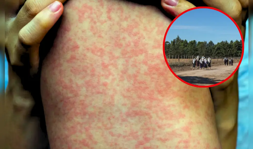 Los brotes de sarampión en EE.UU., especialmente en Texas, están relacionados con la disminución de la vacunación en los últimos años.  Foto: Composición LR/ Telemundo