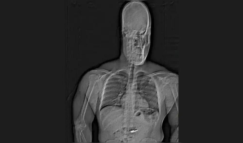 La policía de Orlado publicó la imagen de rayos X de Gilder, que mostró un objeto extraño en su abdomen. Foto: composición LR/Departamento de Policía de Orlando. La policía de Orlado publicó la imagen de rayos X de Gilder, que mostró un objeto extraño en su abdomen. Foto: composición LR/Departamento de Policía de Orlando.
