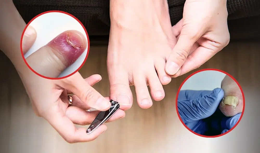 Las peligrosas enfermedades que puedes contraer por compartir el cortaúñas con otras personas: herpes entre las infecciones. Foto: composición LR/podoactiva/almirallmed/CentralCoastOrthopedic