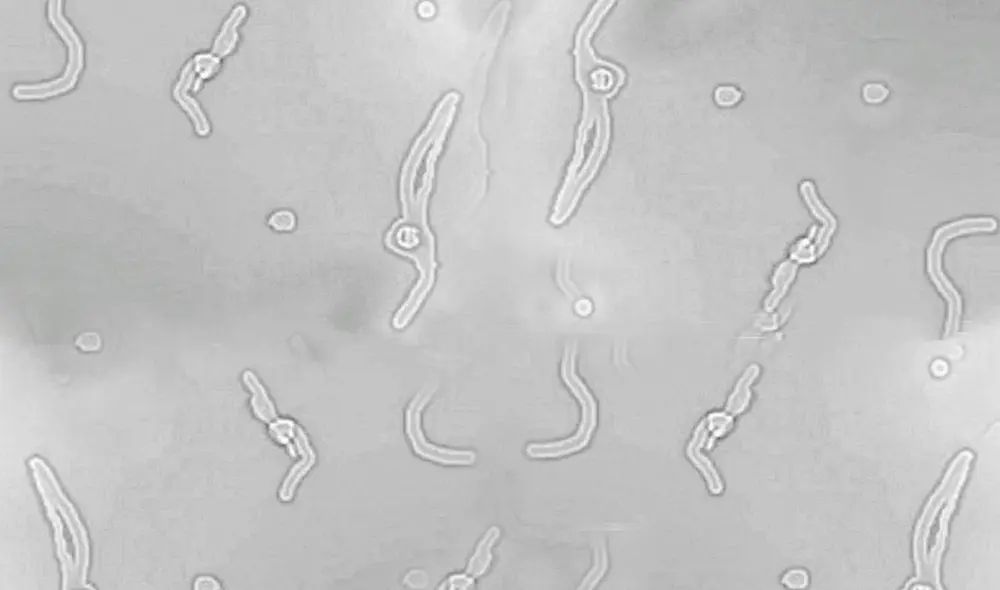 Las miodesopsias, también conocidas como moscas volantes, son acumulaciones de colágeno que se forman en el humor vítreo del ojo.