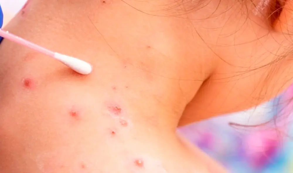 El sarampión no solo es altamente contagioso, sino que también puede causar complicaciones graves. Foto: ABC7